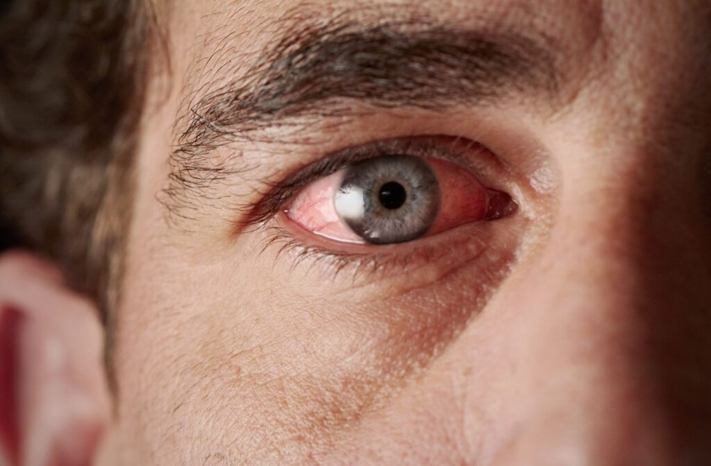 A close-up image of a man with a red, irritated-looking eye.