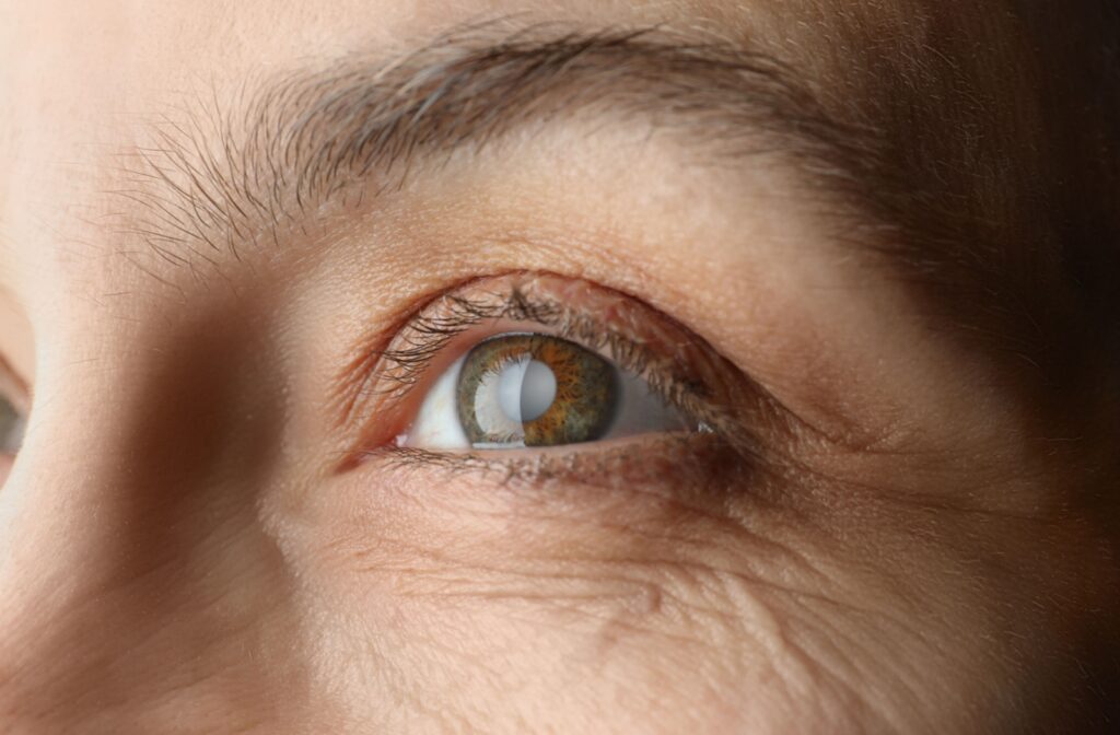 A close-up image of someone's eye partially clouded with glaucoma.